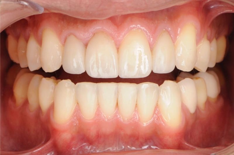Crown Replacement for Better Oral Health and Aesthetics