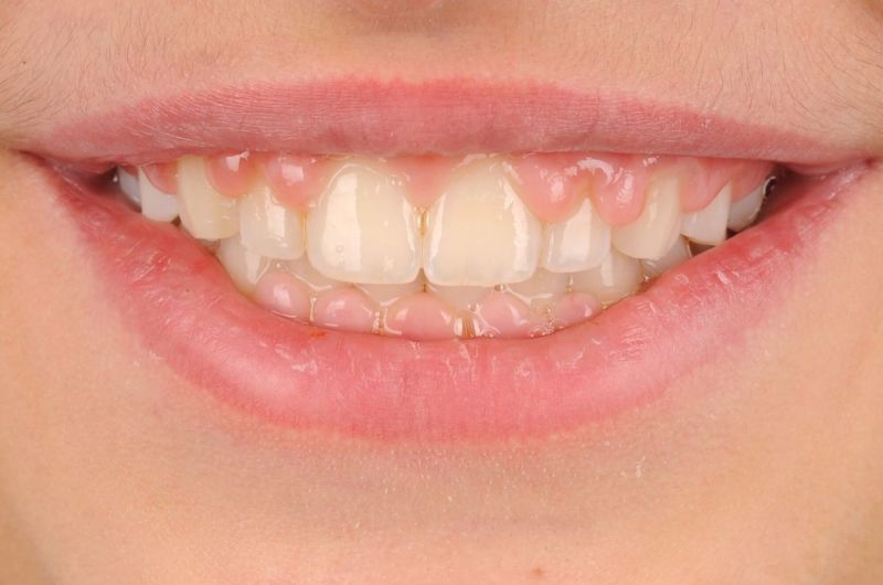After Orthodontic Treatment