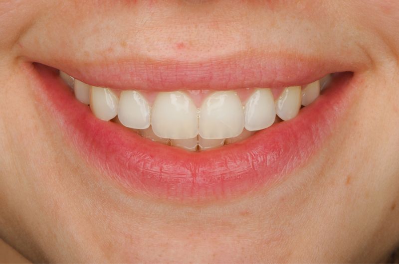 After Gingivectomy