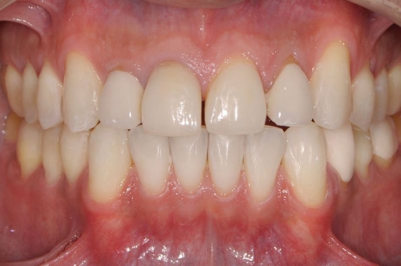 Crown Replacement for Better Oral Health and Aesthetics