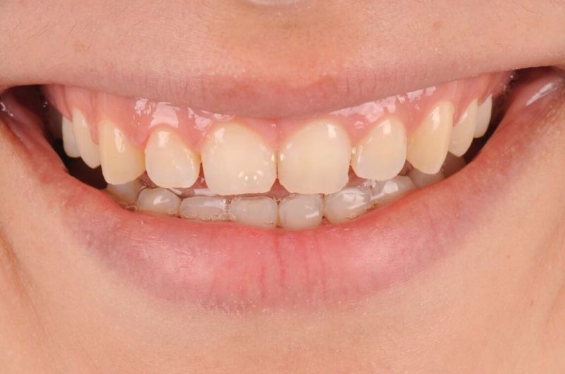 Aesthetic Enhancement with Six Upper Veneers