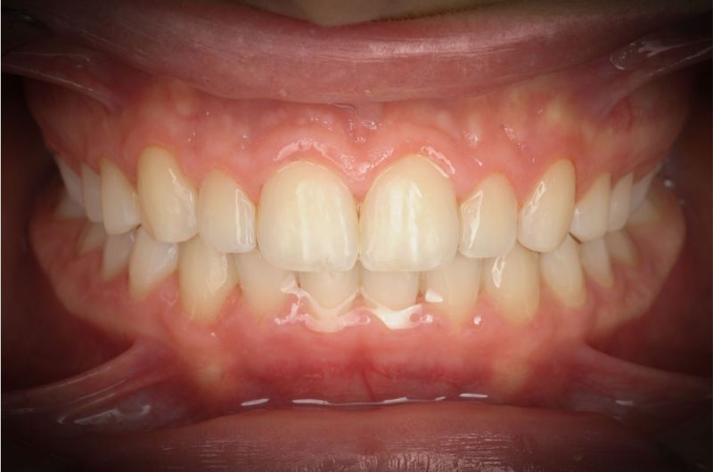 After Gingivectomy