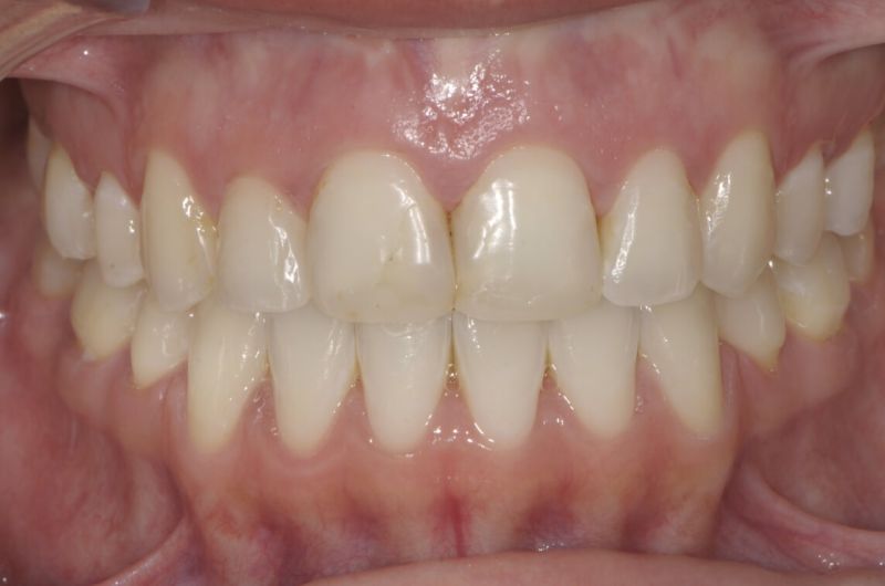 Achieving Color Stability and Smile Enhancement