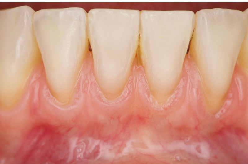 Strengthening Gingiva with Connected Tissue Graft