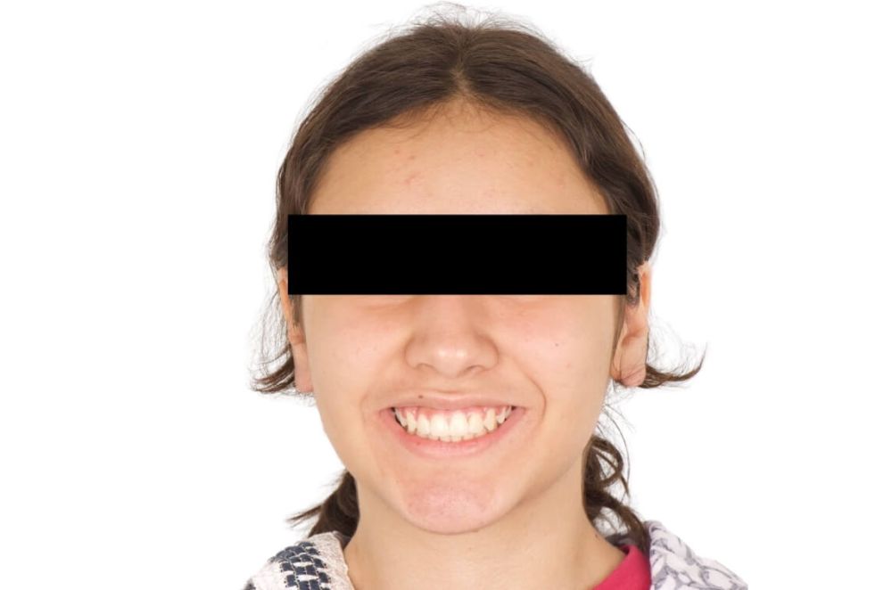 Misalignment and Deep Overbite_after