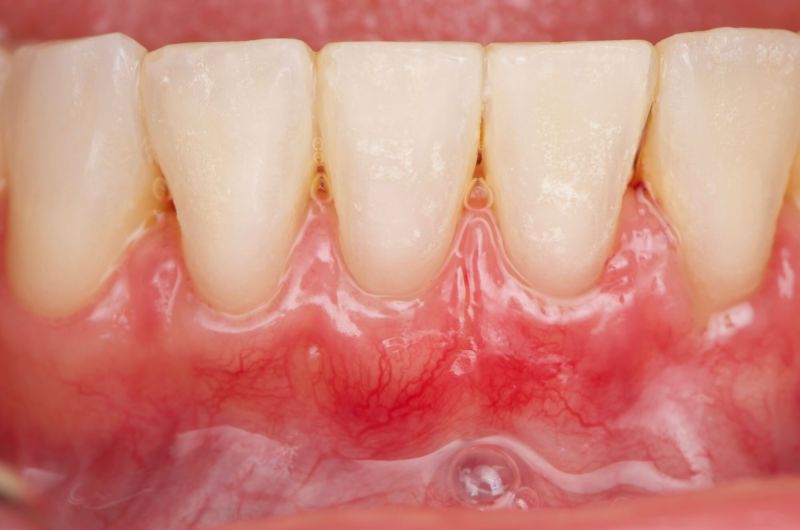 Strengthening Gingiva with Connected Tissue Graft