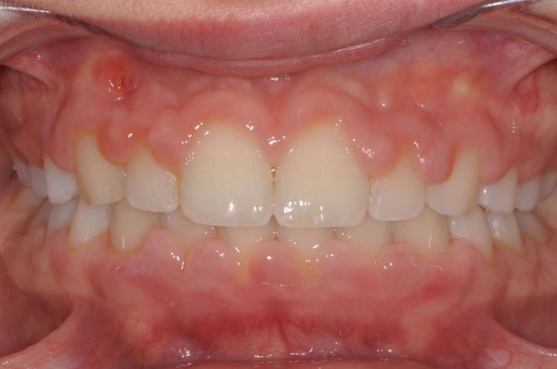 After Orthodontic Treatment