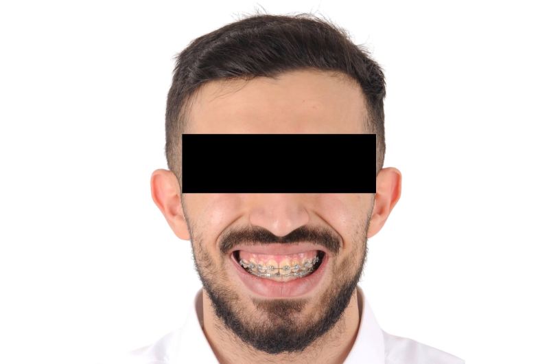 Pre-Orthognathic Surgery
