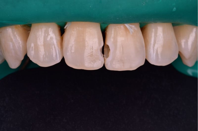 Natural Aesthetic Restoration of Front Tooth Cavities
