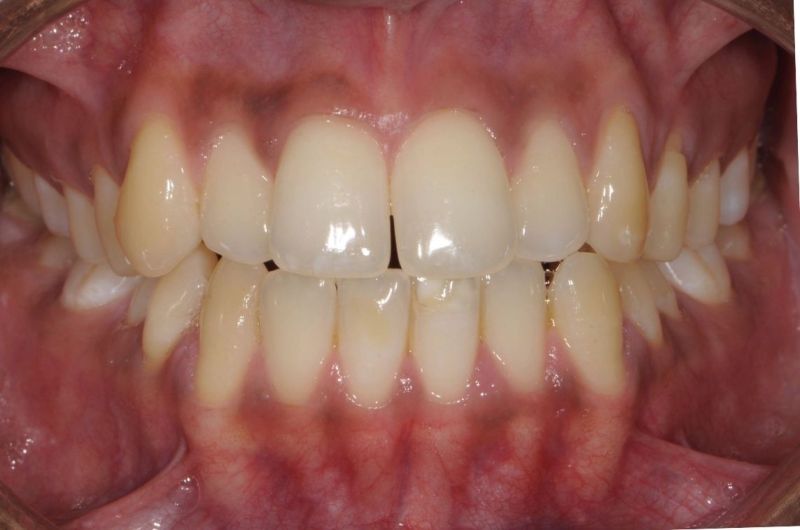 Fixing Midline Gaps and Bite Alignment with Invisalign