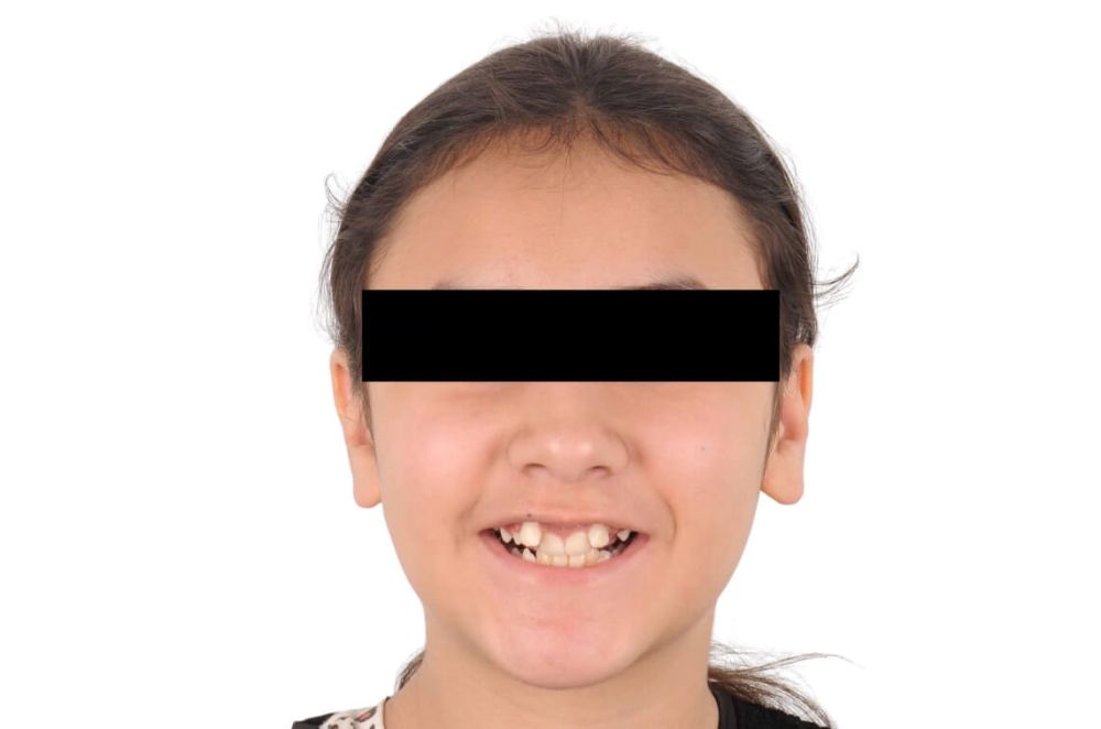 Misalignment and Deep Overbite_before