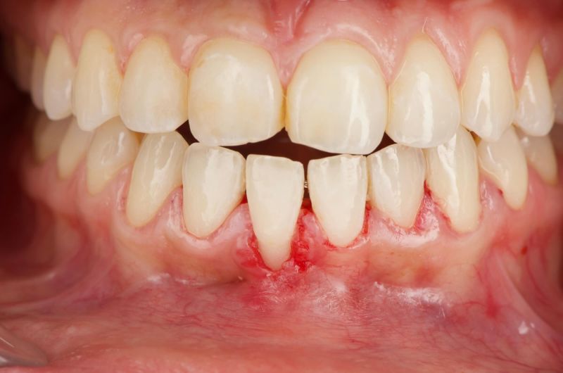 Restoring Gum Health Before Orthodontic Treatment