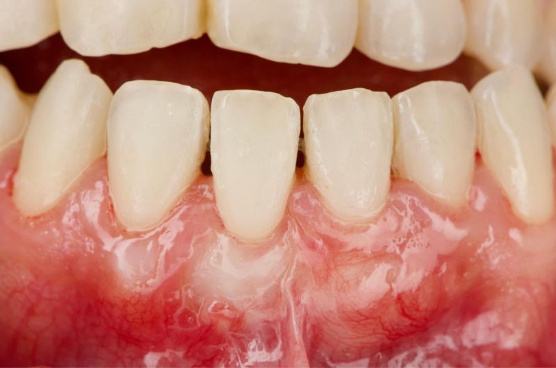 Restoring Gum Health Before Orthodontic Treatment