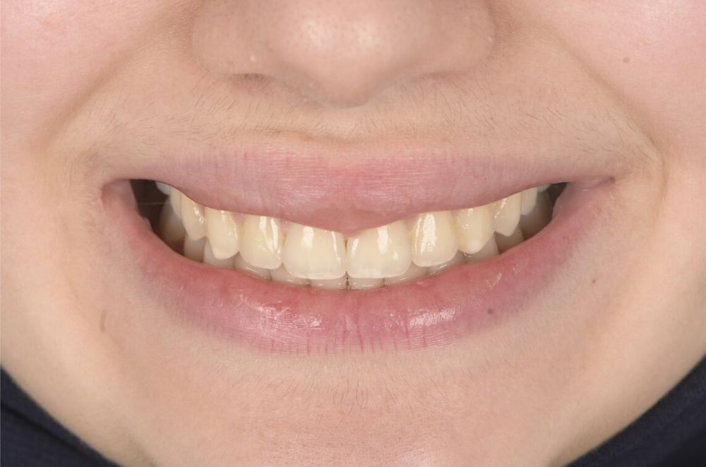 Class II, Anterior Open Bite_after