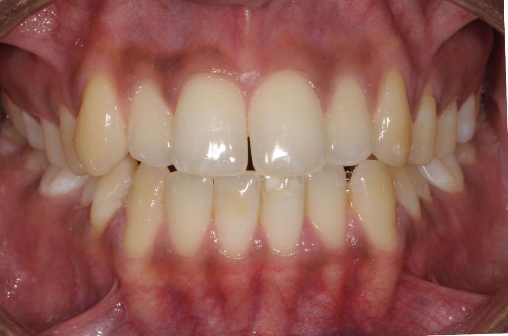 Fixing Midline Gaps and Bite Alignment with Invisalign_before