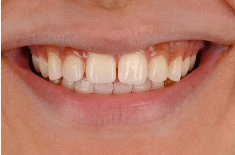 Protrusion of Upper Front Teeth