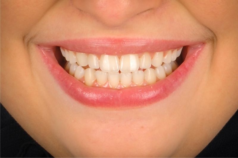 Correcting Crowding and Gummy Smile