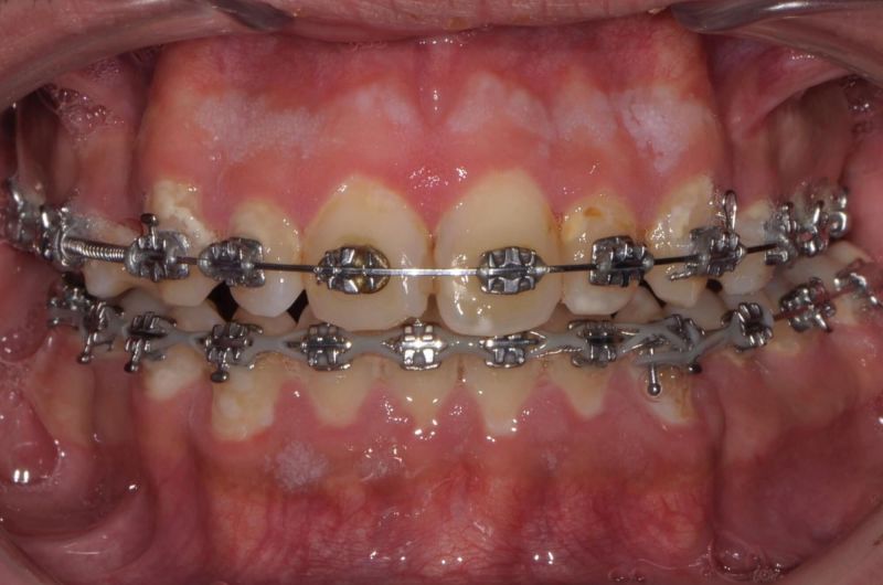 Pre-Orthognathic Surgery
