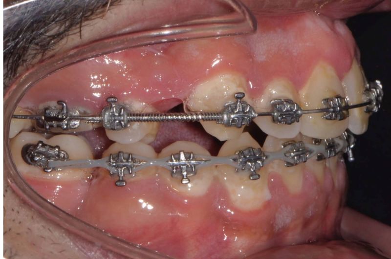 Pre-Orthognathic Surgery