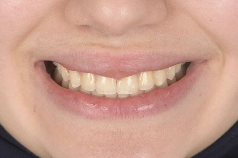 Class II, Anterior Open Bite
