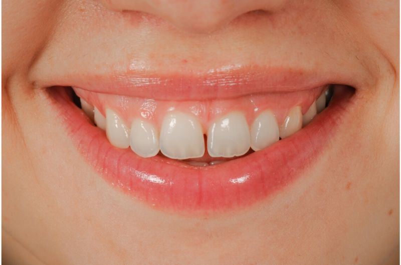 Resolving Open Bite, Protrusion and Spacing with Invisalign
