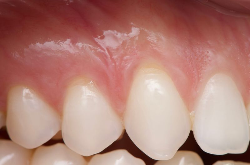 Connective Tissue Graft Procedure On Upper Canines