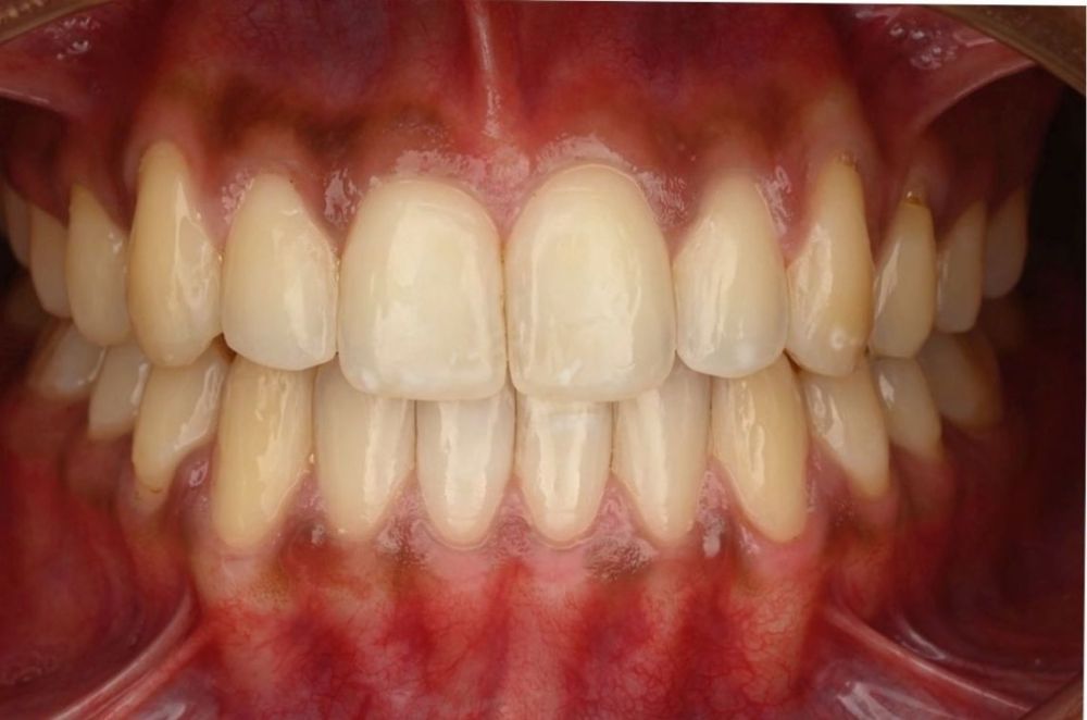 Fixing Midline Gaps and Bite Alignment with Invisalign_after