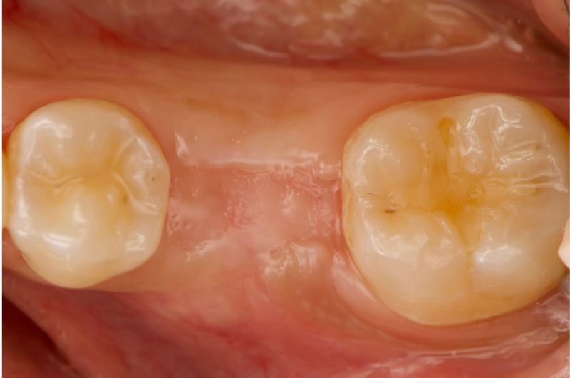 Atraumatic Extraction, Bone Grafting and Implant Placement