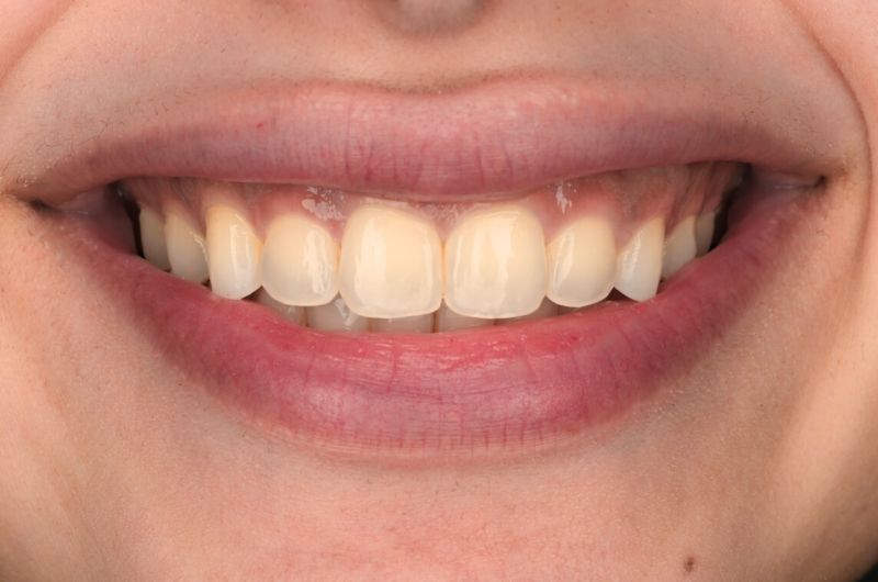 Protrusion of Upper Front Teeth