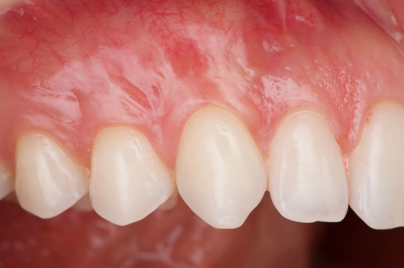 Connective Tissue Graft Procedure On Upper Canines