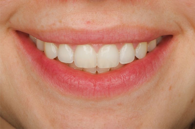 Resolving Open Bite, Protrusion and Spacing with Invisalign