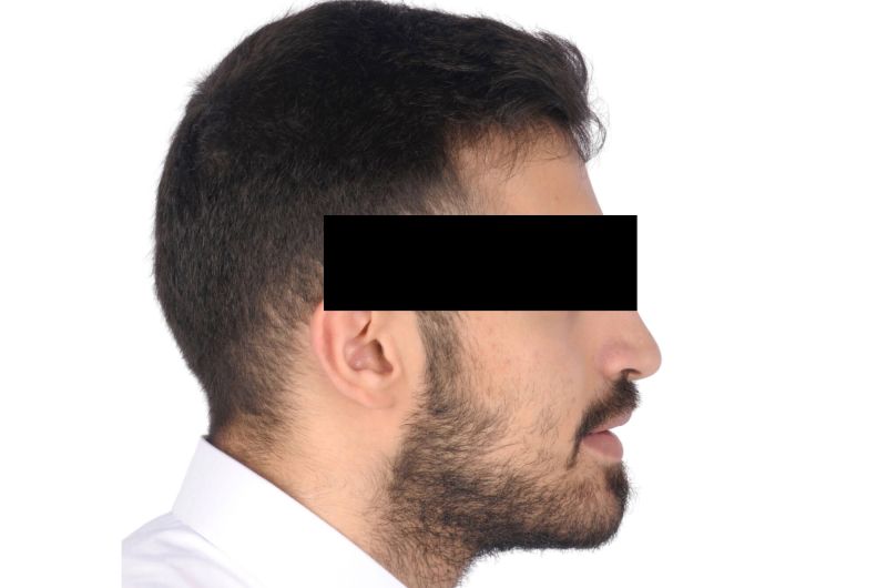 Post Orthodontic Treatment and Orthognathic Surgery