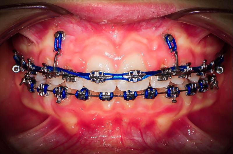 During Orthodontic Treatment