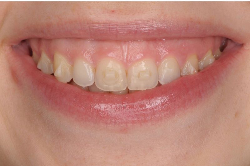 After Orthodontic Treatment