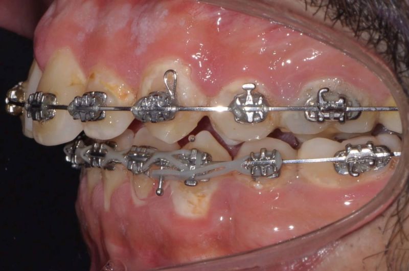 Pre-Orthognathic Surgery