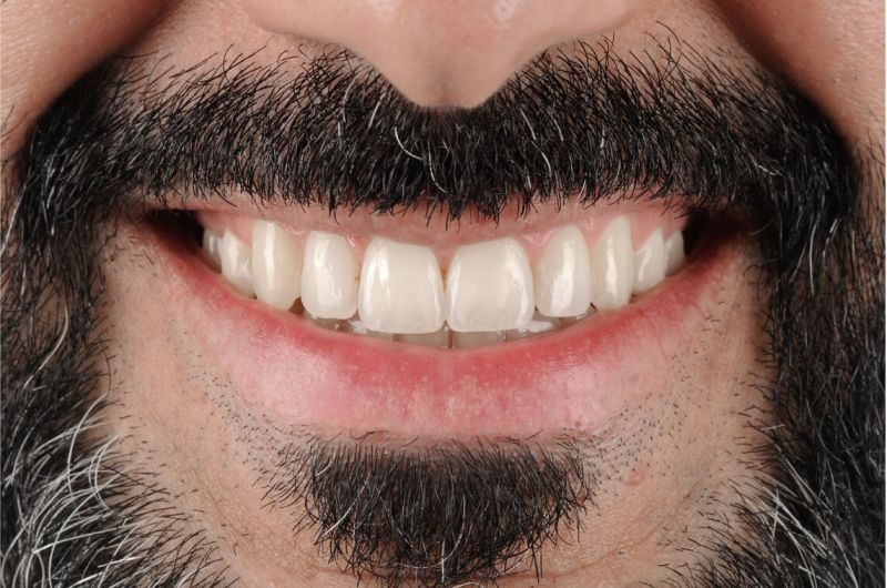 Protrusion Case Treated with Invisalign