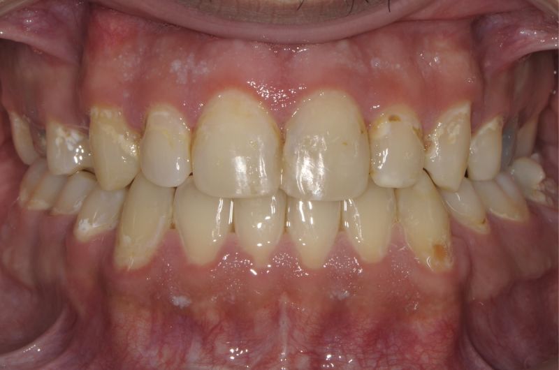 Post Orthodontic Treatment and Orthognathic Surgery