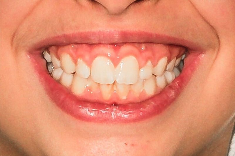 Correcting Crowding and Gummy Smile