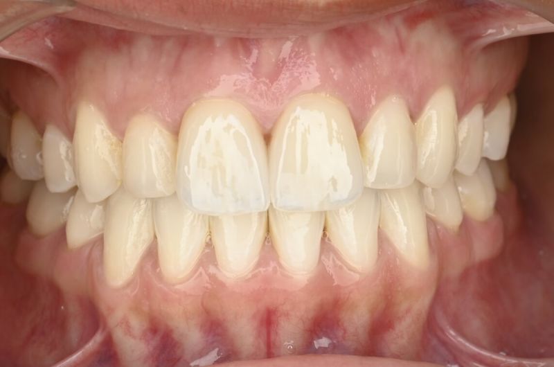 Achieving Color Stability and Smile Enhancement