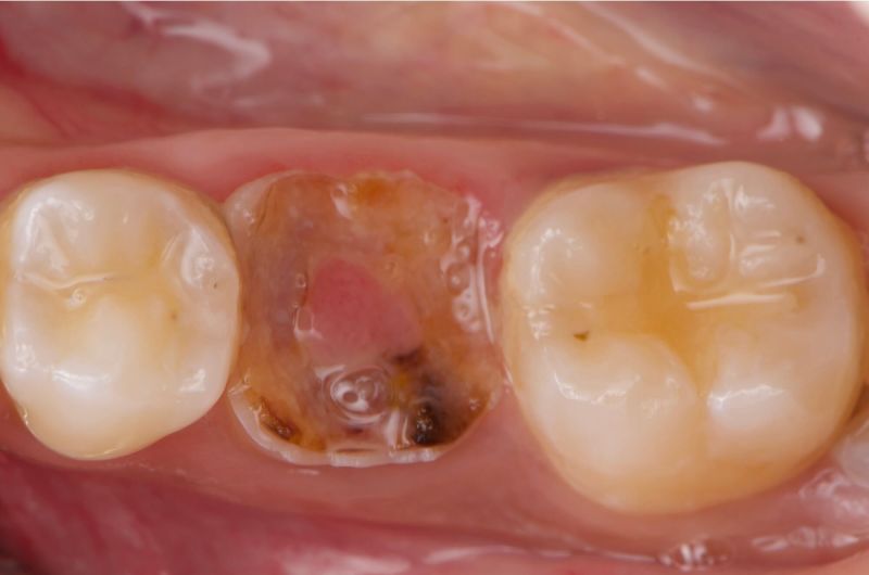 Atraumatic Extraction, Bone Grafting and Implant Placement