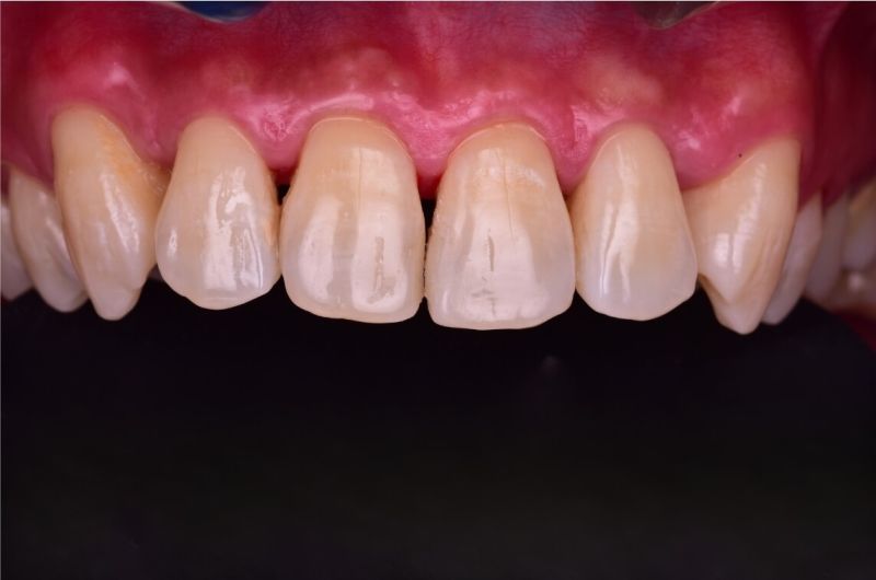 Natural Aesthetic Restoration of Front Tooth Cavities