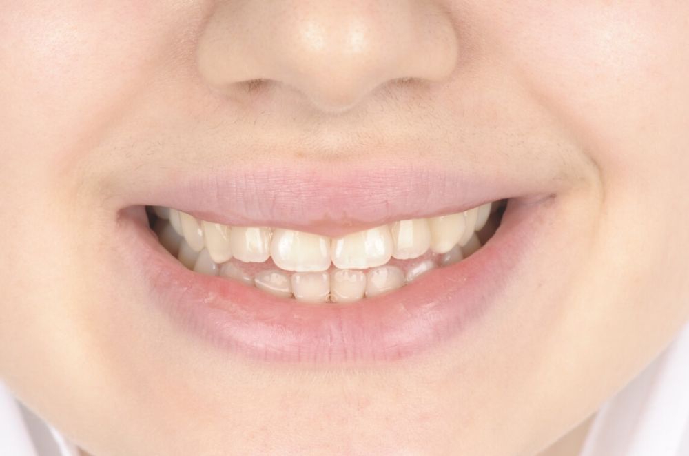 Class II, Anterior Open Bite_before