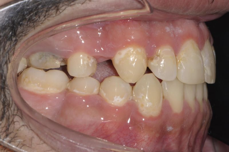 Post Orthodontic Treatment and Orthognathic Surgery