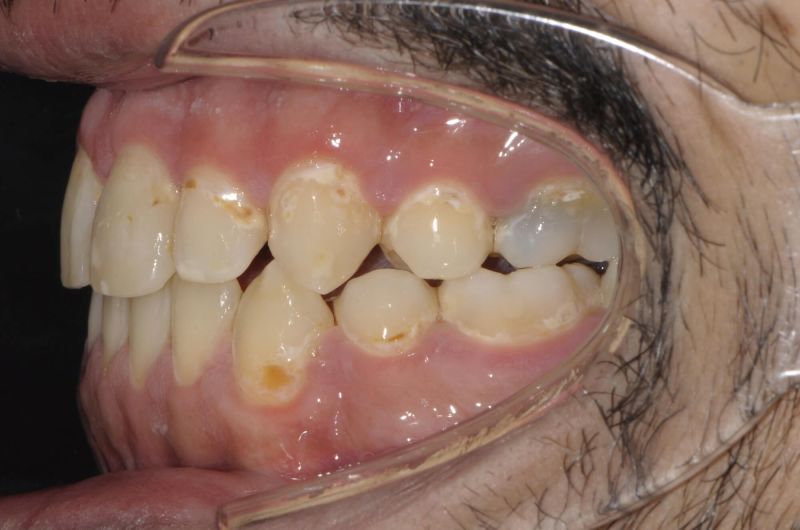 Post Orthodontic Treatment and Orthognathic