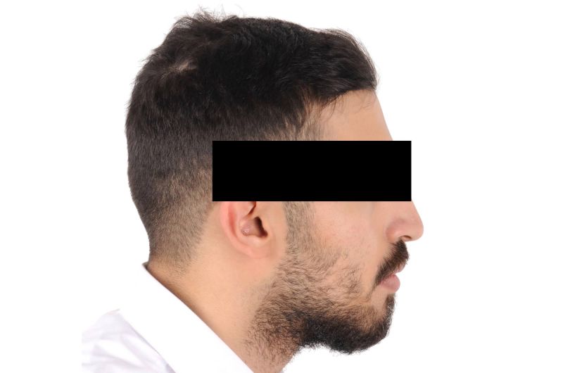Pre-Orthognathic Surgery