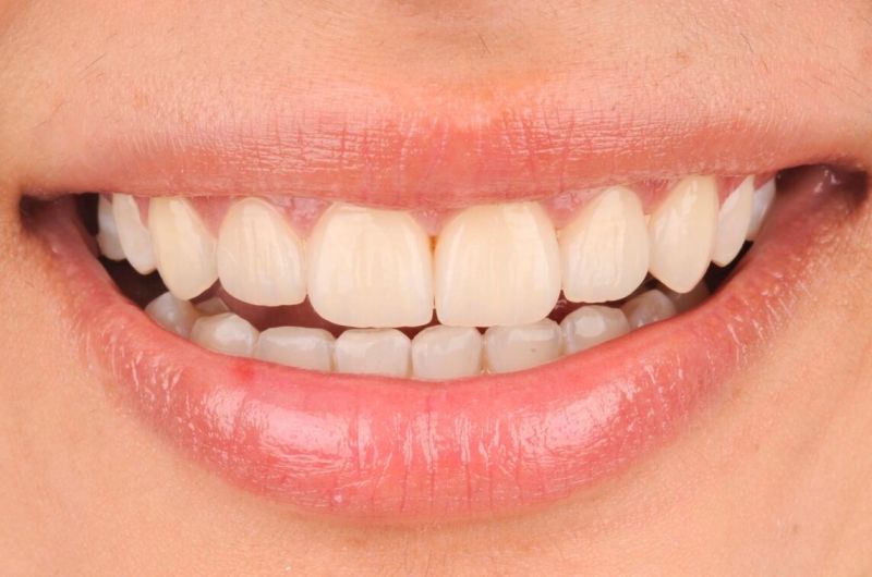 Aesthetic Enhancement with Six Upper Veneers
